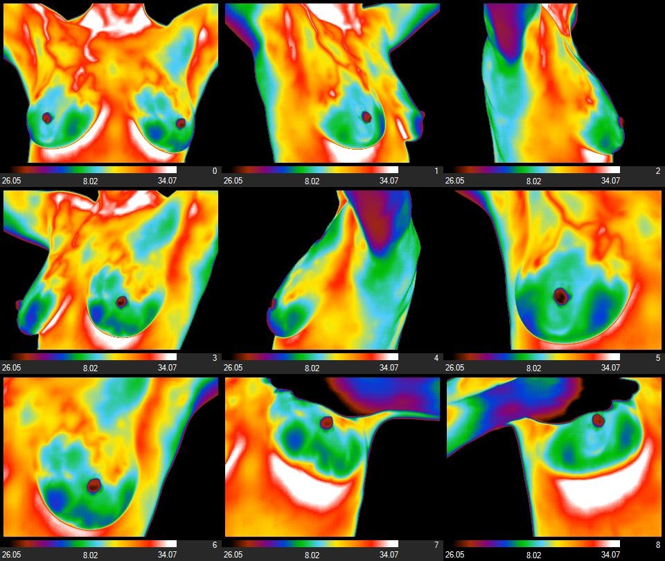 Breast thermography Example